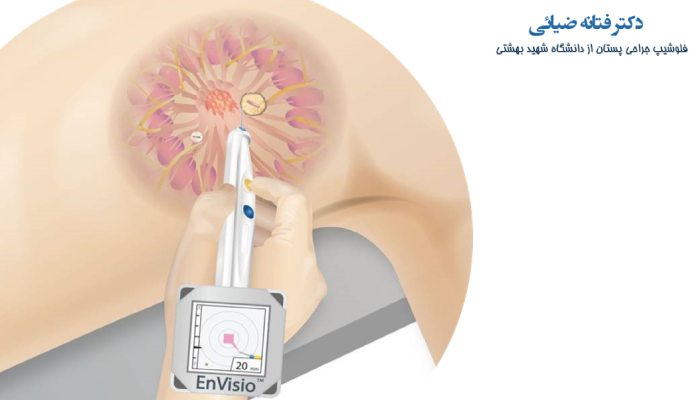 انواع مارکر گزاری توده های پستان
