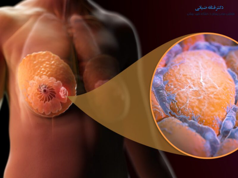 مارکر گذاری توده های پستان