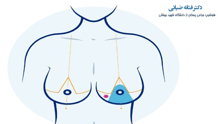 روش آنکوپلاستی