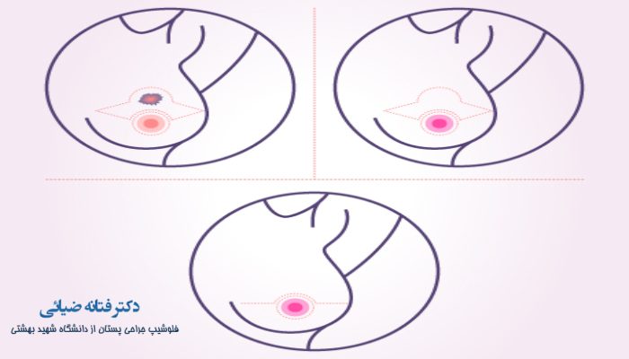 مزایای آنکوپلاستی