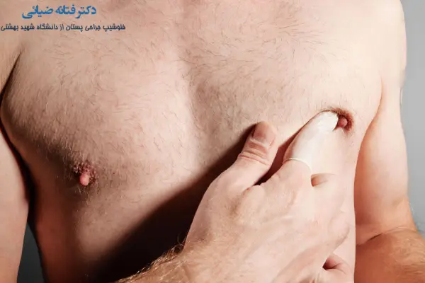 درمان سرطان پستان در مردان