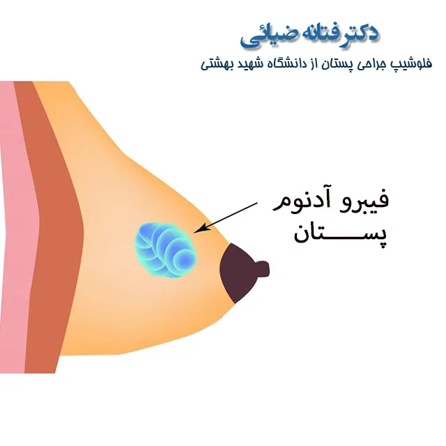 نشانه های فیبرو آدنوم