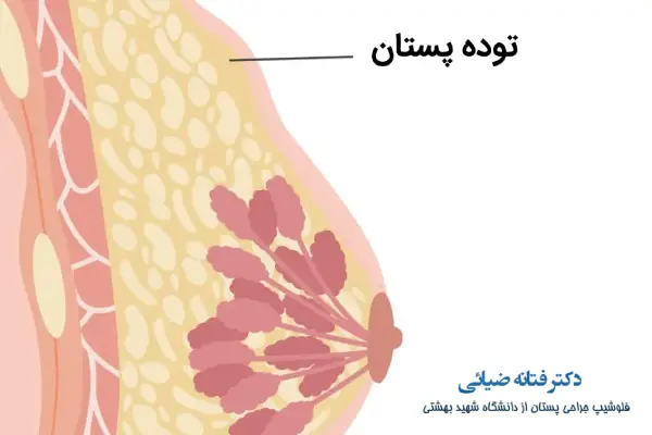 توده خوش خیم پستان چیست؟