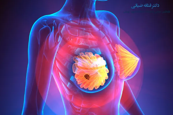 بهترین روش نمونه برداری از پستان