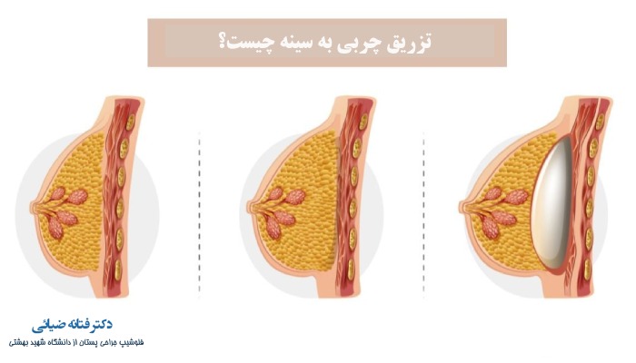 تزریق چربی به سینه چیست؟