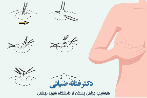 شماتیک روش جراحی فرورفتگی پستان 