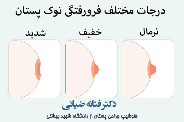 عکس گرافیکی پستان از درجات مختلف فرورفتگی نوک سینه