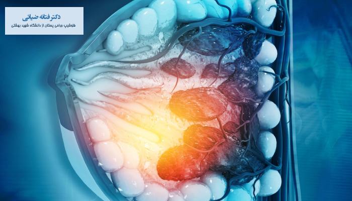 درمان ماستیت گرانولوماتوز