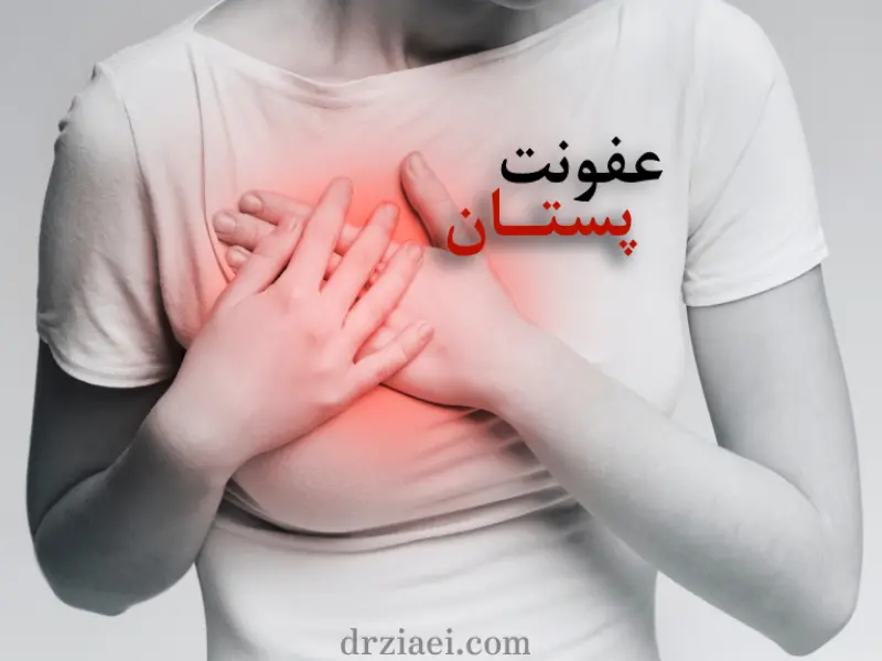 عفونت پستان