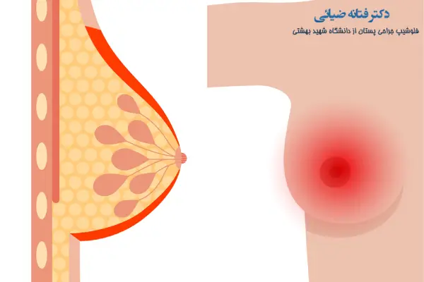 علت سرطان سینه تهاجمی