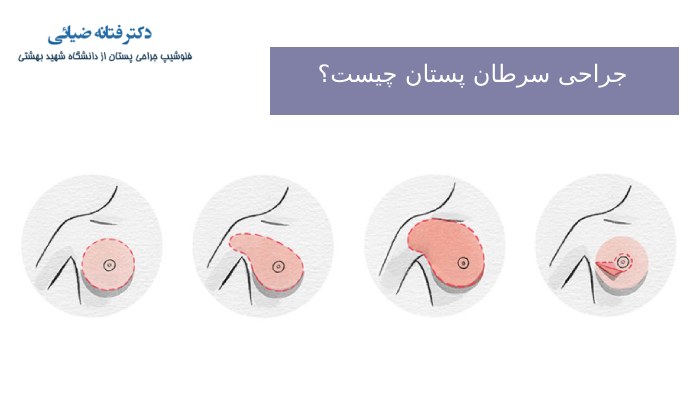 جراحی سرطان پستان چیست؟