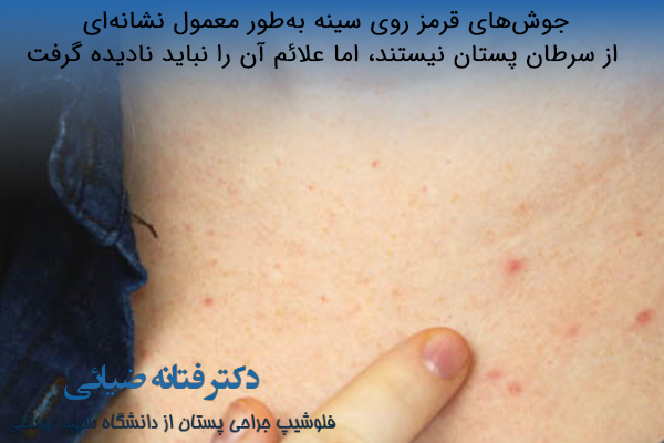 جوش قرمز روی پستان