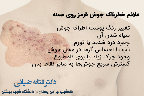 علائم خطرناک جوش قرمز روی سینه