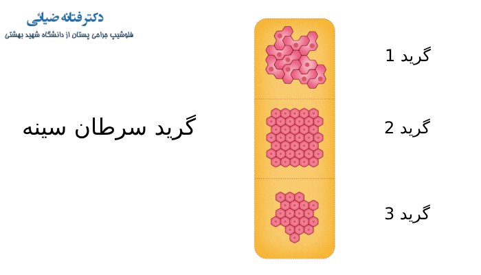 گرید سرطان سینه