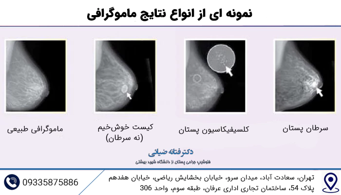 نمونه ای از انواع نتایج ماموگرافی