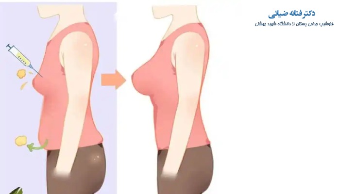 هزینه تزریق چربی سینه