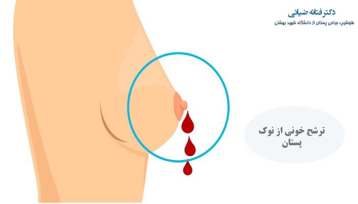 ترشح خونی از نوک پستان