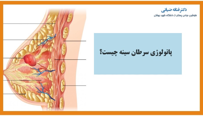 پاتولوژی سرطان سینه چیست؟