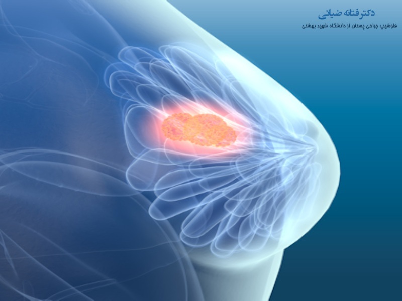 پاتولوژی سرطان سینه