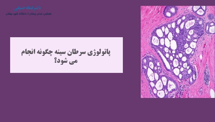 پاتولوژی سرطان پستان