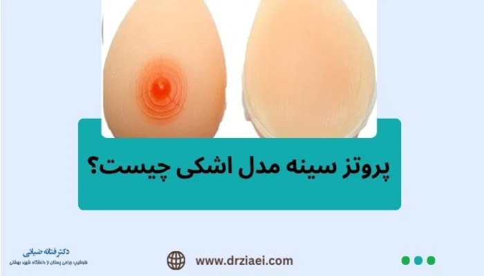 پروتز سینه مدل اشکی چیست؟