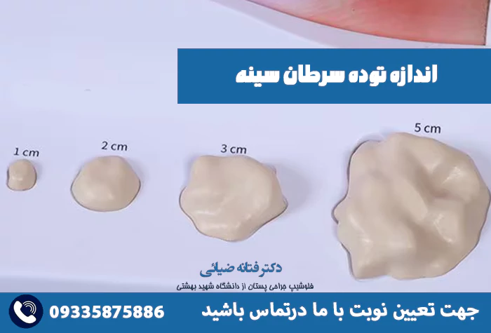 اندازه توده سرطان سینه
