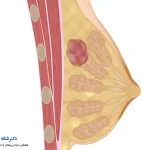 اندازه و شکل توده سرطانی