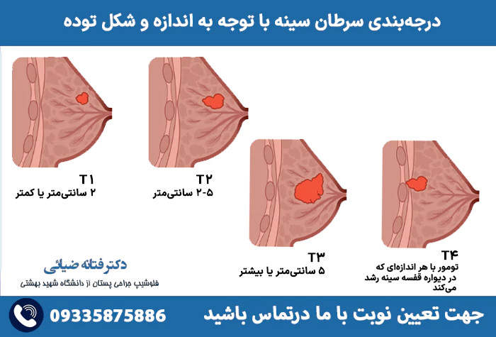درجه‌بندی سرطان سینه با توجه به اندازه و شکل توده