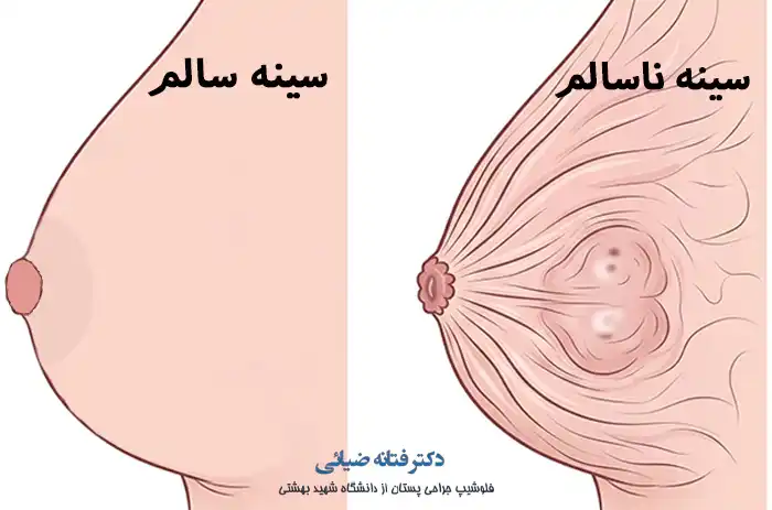 عکس سینه سالم و ناسالم