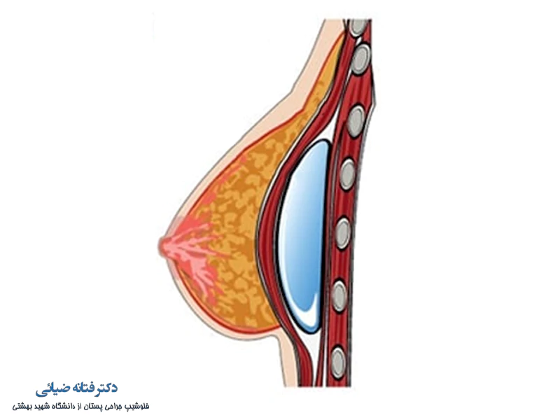 پروتز سینه در زیر عضله سینه