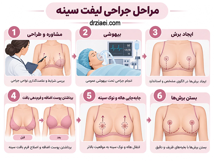 اینفوگرافیک از مراحل جراحی لیفت صورت